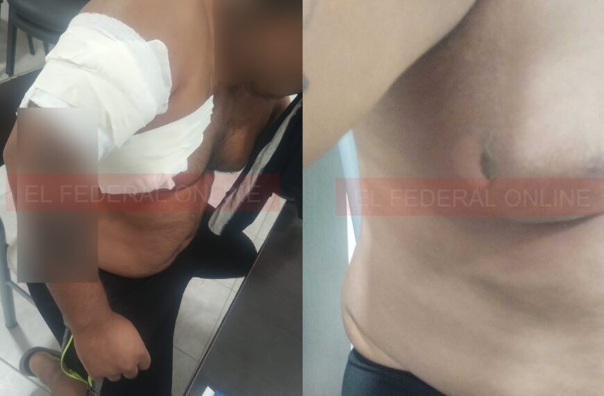 Un hombre denunció que su pareja le tiró agua hirviendo en medio de una discusión